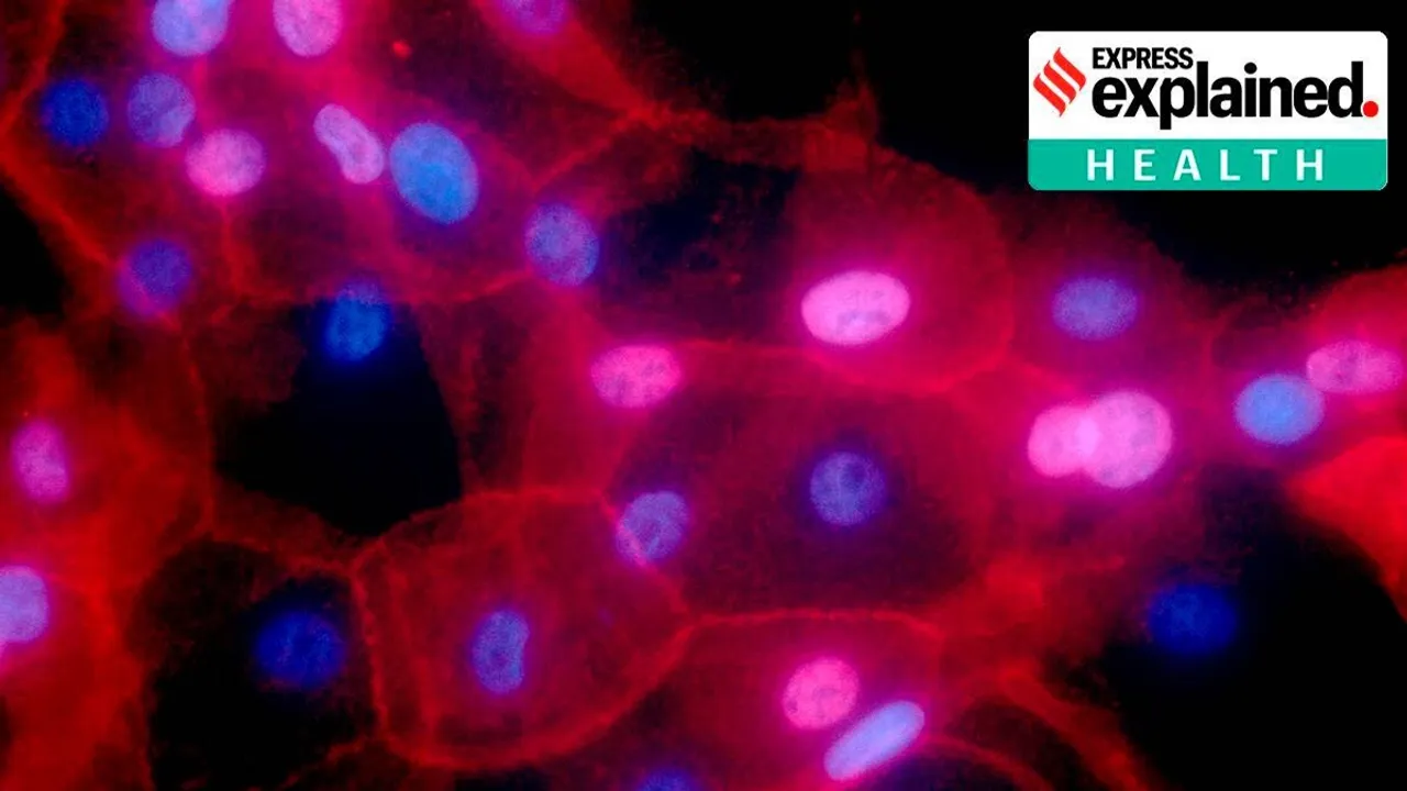 Cancer drug trial, drug cures cancer, Cancer patients, Cancer treatment, dostarlimab, rectal cancer, Memorial Sloan Kettering Cancer Centre, Express Explained, The Indian Express