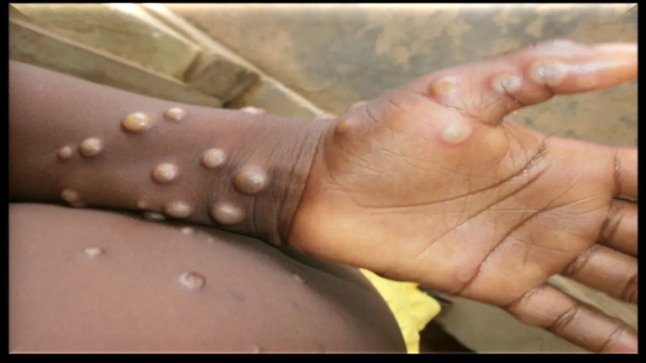 Kerala issues statewide alert as monkeypox patient detection