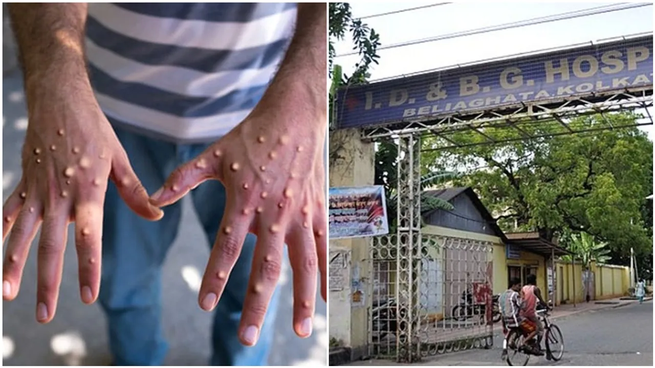 west bengal health dept issues guideline for monkeypox