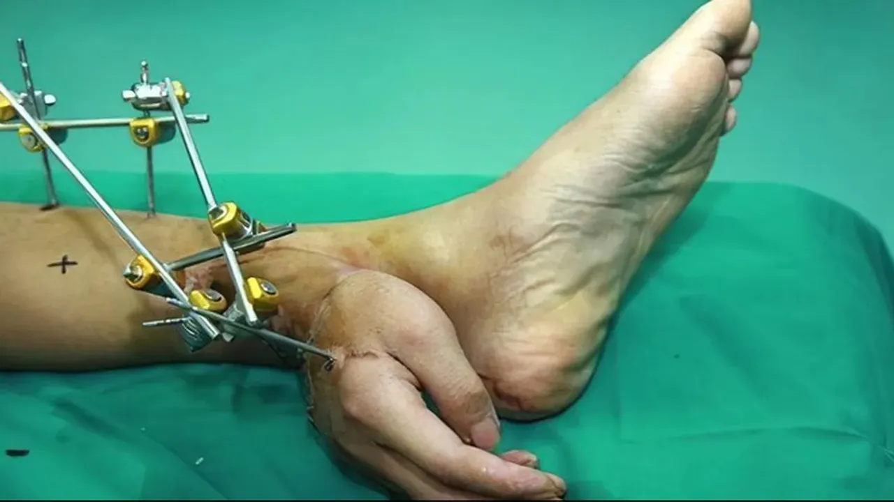 Viral News,China hand attached with legs,Cut off Hands feet finger preservation tips,Chinese Doctors,Doctors save man severed hand,Severed hand attached to man ankle,Saving a severed hand by grafting to a leg,Chinese man,Viral post,Shocking News,trending story,Amazing Story,Trending Video,Viral News In Hindi,Viral Video News,zara hatke,ndtv zara hatke videos,news,Social Media,Entertainment News In Hindi,Tv News And Gossip,Amazing Video,Shocking Video,hilarious video,Weird news,Ajab Gajab news,scary