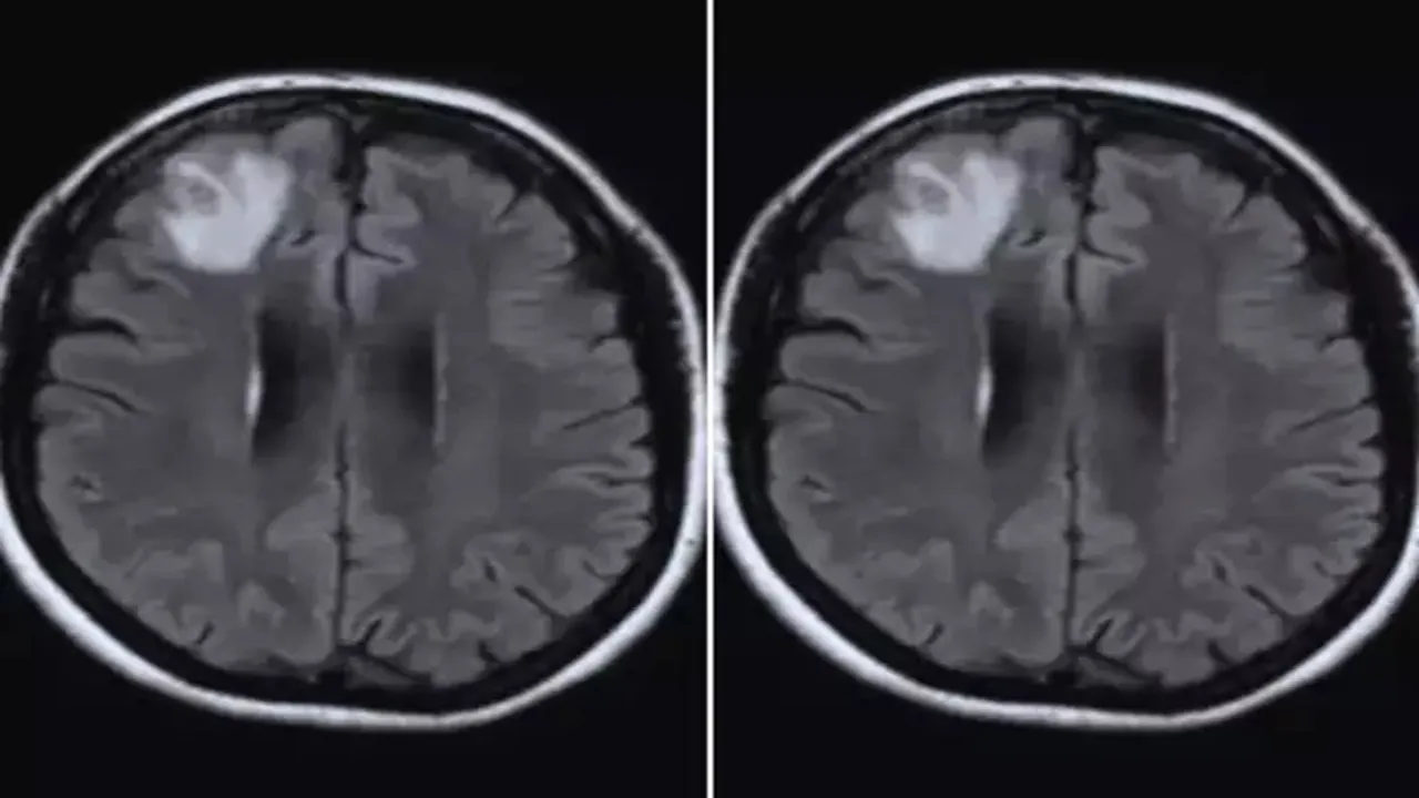 worm living in woman brain first case discovered by doctors
