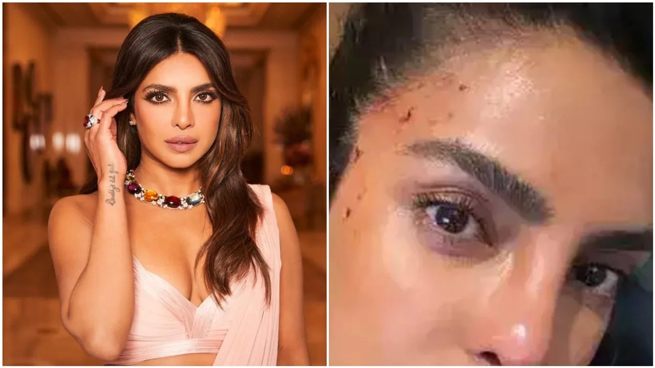 priyanka chopra, priyanka chopra bruise, priyanka chopra news, priyanka chopra bollywood, priyanka chopra update, priyanka chopra lifestyle, priyanka chopra injured, priyanka chopra entertainment news
