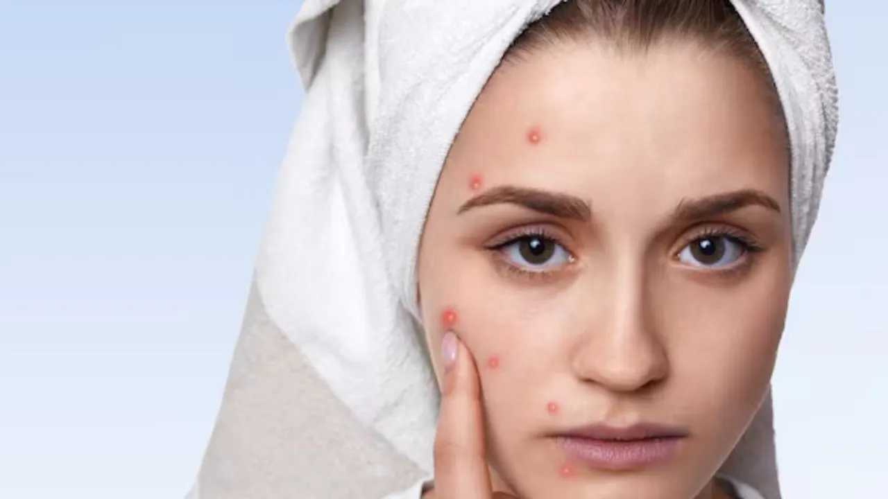 Home remedies to remove acne