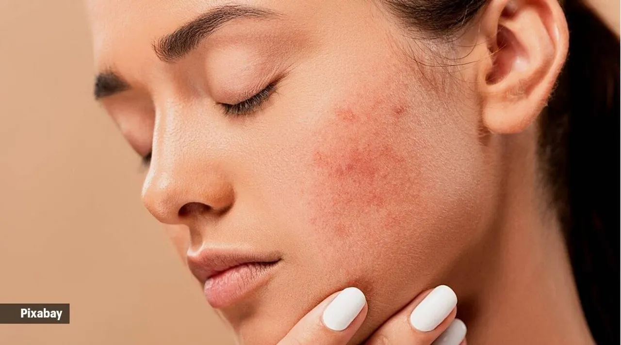 While redness on the skin is not always a casue for concern, it can be irritating and uncomfortable. (Photo: Pixabay)