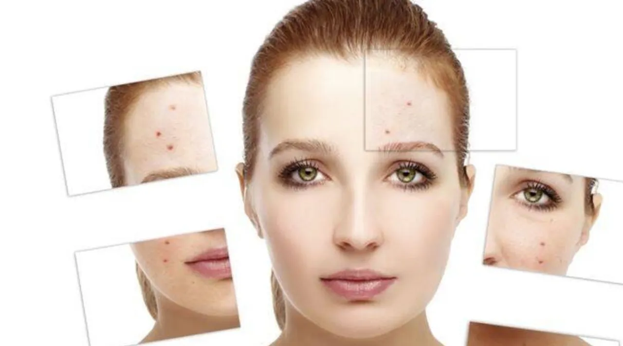 These common gym habits cab aggravate acne