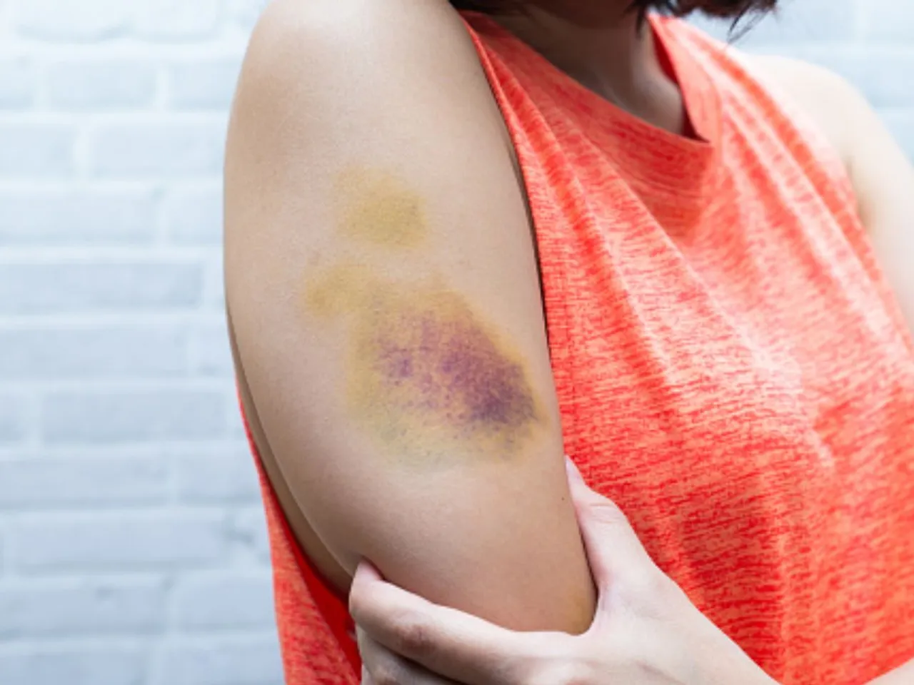 You may notice bruising on the legs due to many reasons (Picture credits : unsplash)