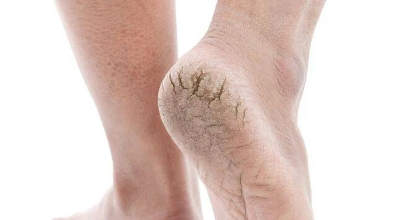 Try these home remedies for cracked heels.