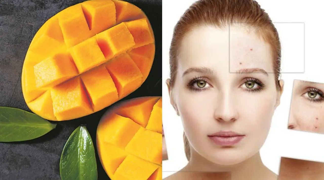 one should make sure they are eating organic mangoes that are naturally ripened, without any artificial carbides, thereby reducing the risk of triggering acne.