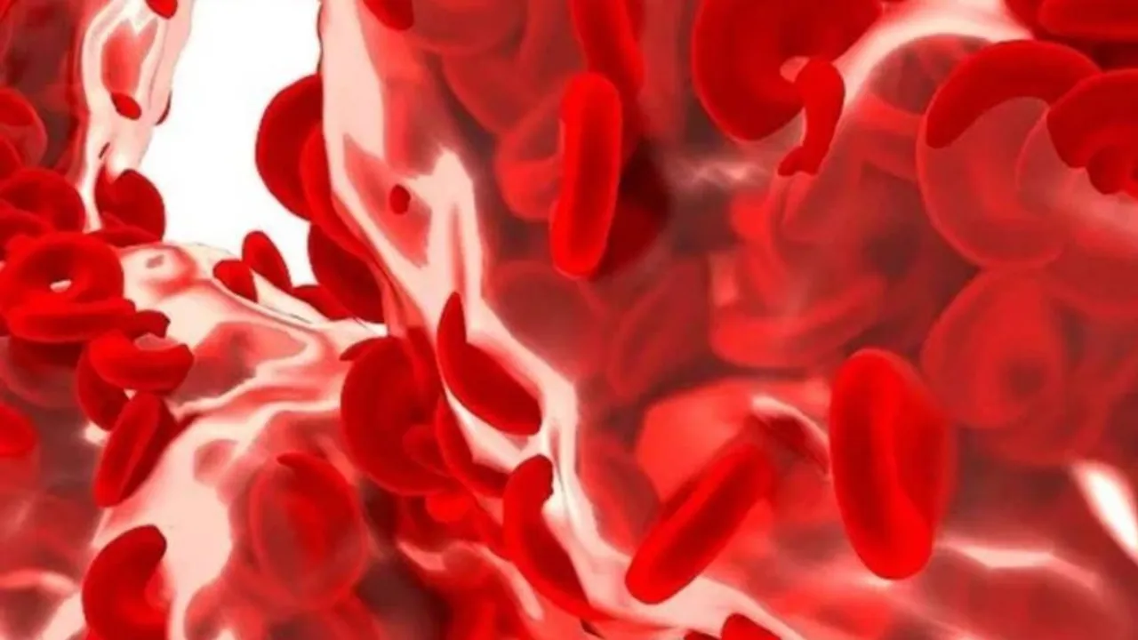 Sickle-cell disease, or sickle-cell anaemia, is a congenital form of anaemia acquired during foetal development, characterised by the presence of sickle cells, or unusual crescent-shaped red blood cells having an abnormal form of haemoglobin