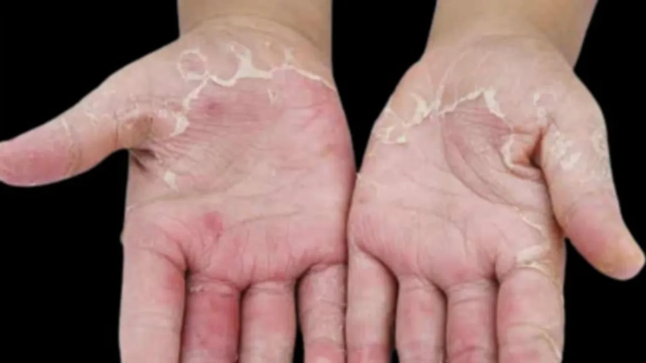 Peeling skin on hands