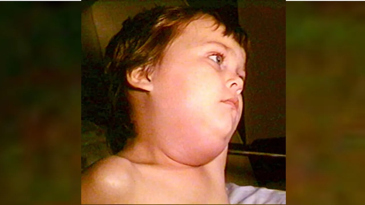 mumps virus | mumps causes | mumps symptoms | mumps treatment | mumps vaccine