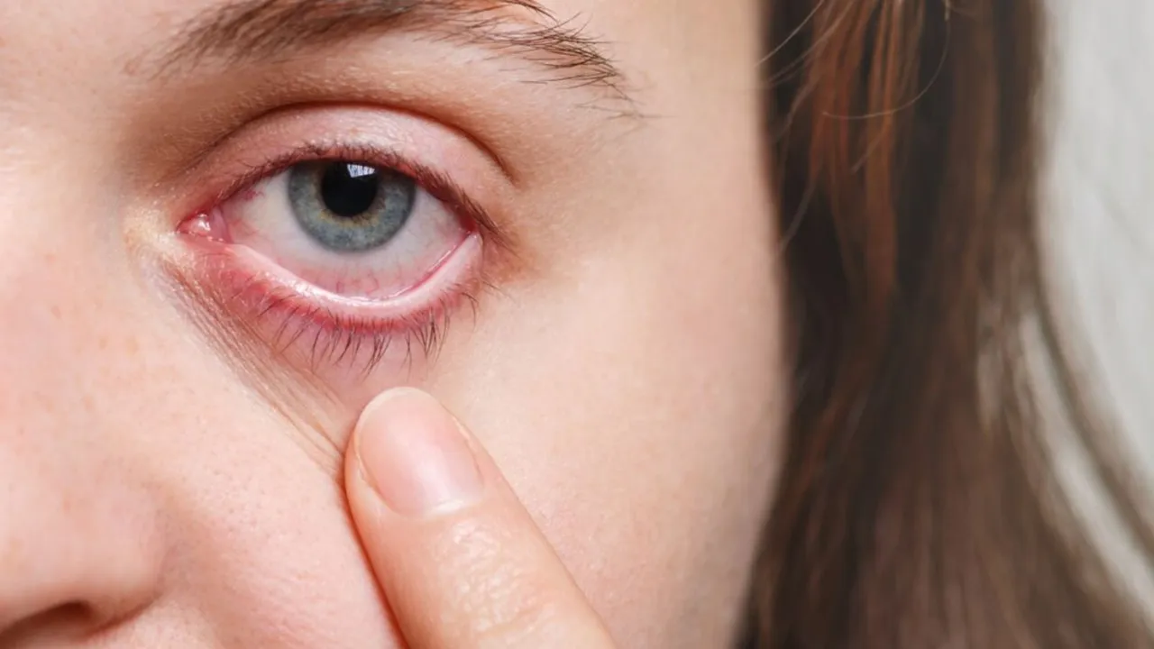conjunctivitis | conjunctivitis tips | how to take care of conjunctivitis