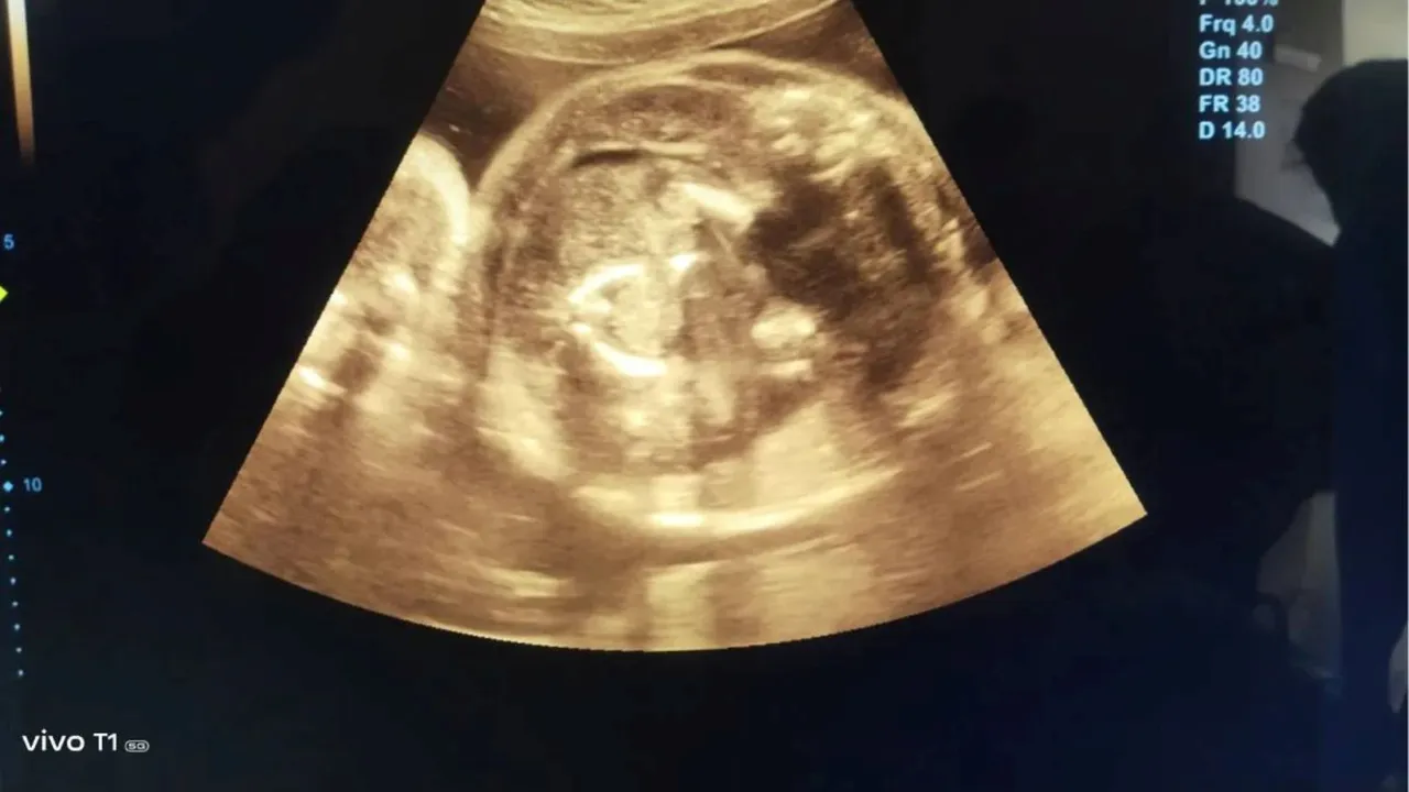 buldhana, pregnant women had baby in her womb another baby in babys stomach,