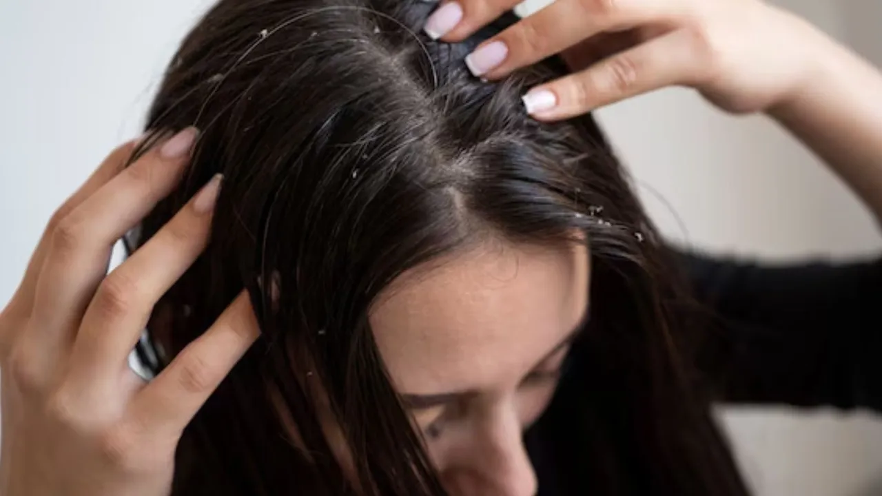 Dandruff home remedies | લીમડાના પાનનો ઉપયોગ કરીને ખોડો દૂર કરવાના ઉપાયો