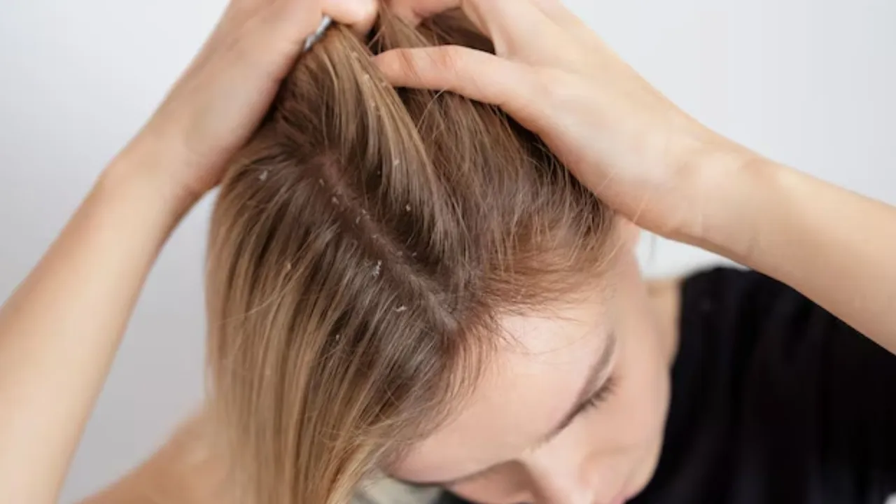 કુદરતી રીતે ખોડો દૂર કરવાના ઘરેલું ઉપાયો