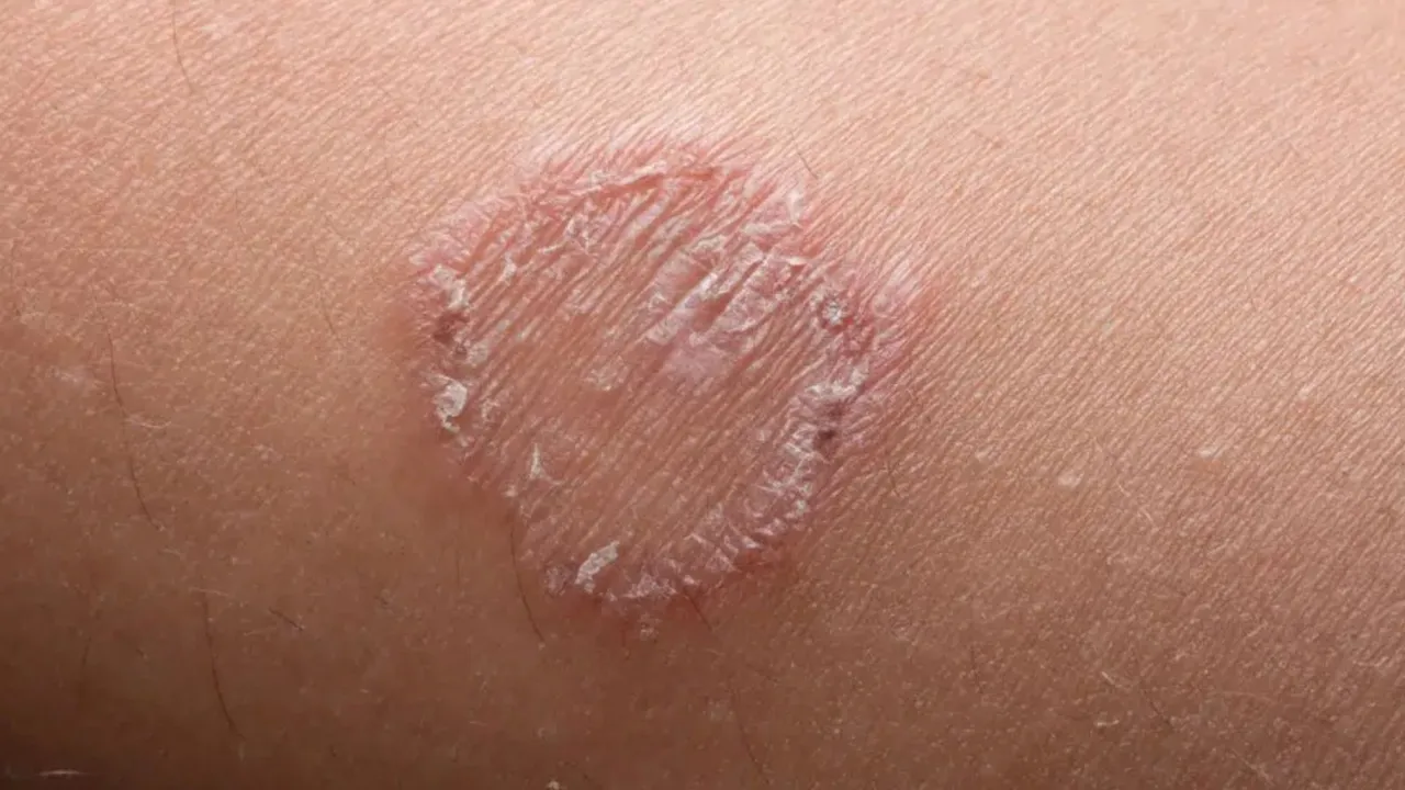 Best medicine for ringworm