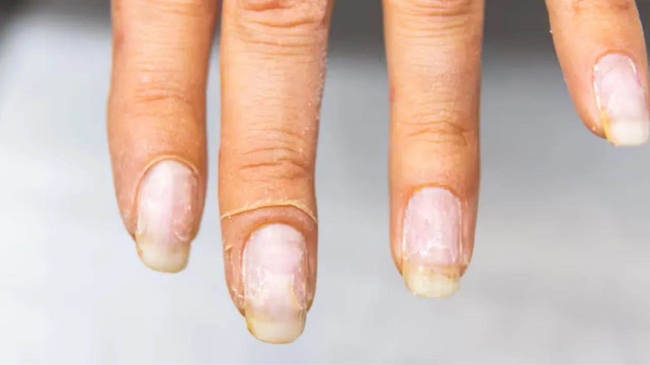નખ પીળા થવાના કારણો છુટકારો મેળવવાના ઉપાય હેલ્થ ટિપ્સ