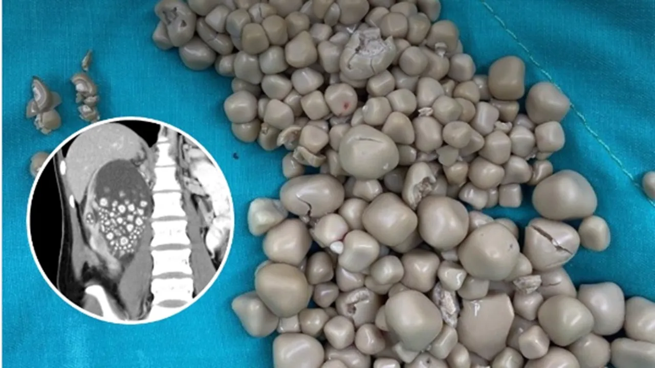 300 kidney stones | Viral post 