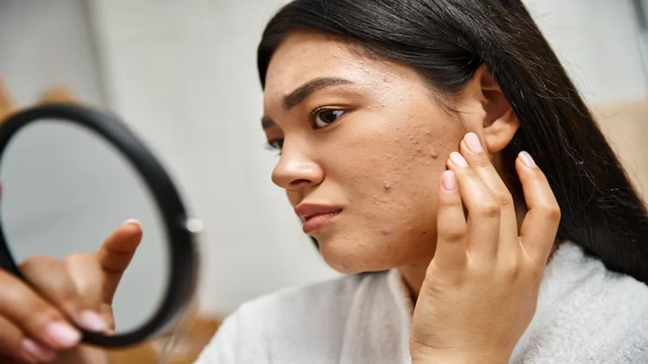 Acne Prone Skin