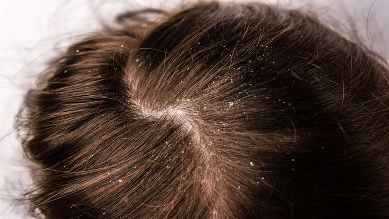 Dandruff Home Made Mask