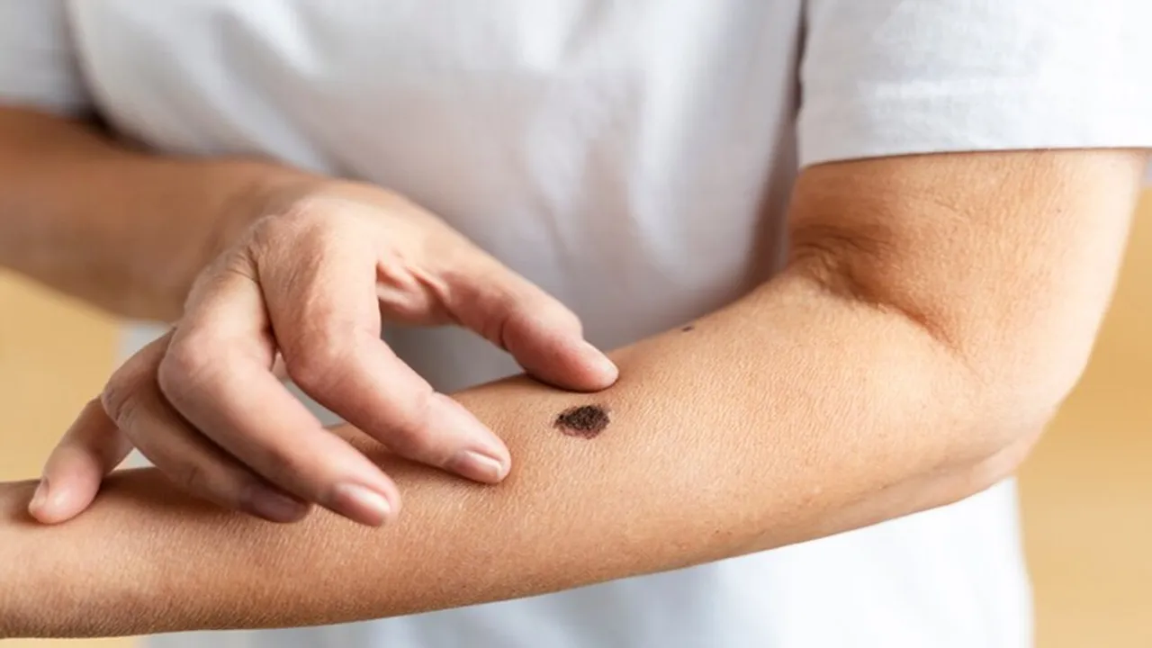 Diabetes Skin