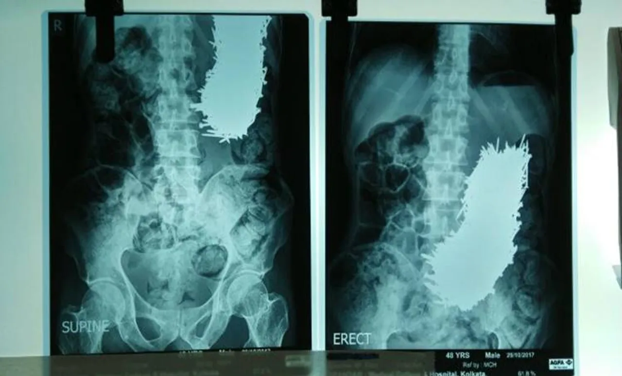 രോഗിയുടെ വയറ്റില്‍ നിന്നും ഡോക്ടര്‍മാര്‍ കാന്തം ഉപയോഗിച്ച് നീക്കം ചെയ്തത്  639 ആണികള്‍