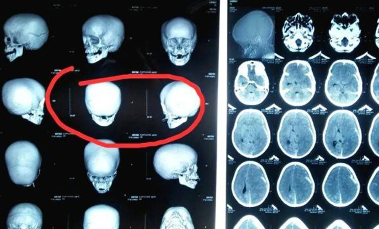 ഏഴു വയസുകാരന്റെ ആരോഗ്യനിലയില്‍ പുരോഗതിയില്ല; തലച്ചോറിന്റെ പ്രവര്‍ത്തനം നിലച്ചു