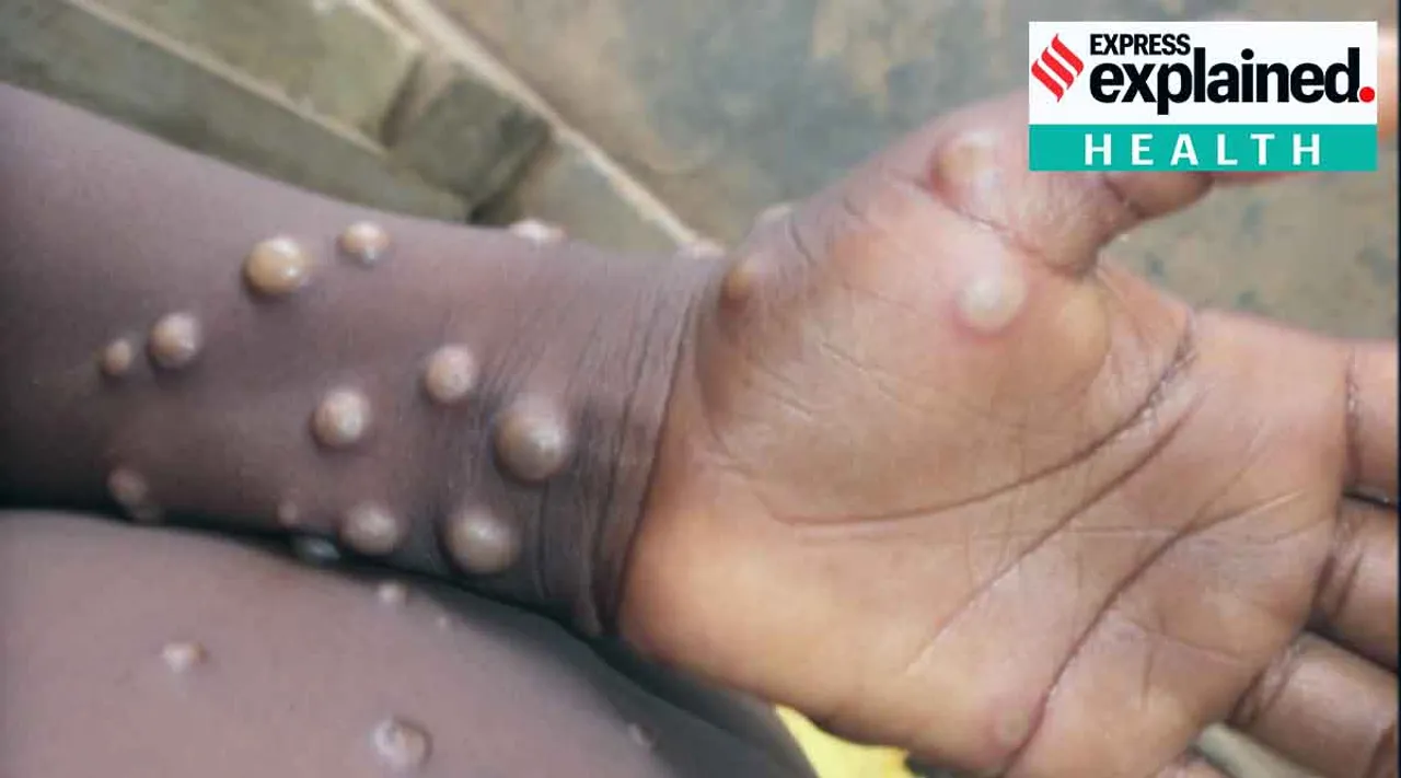 Monkeypox vs smallpox, Monkeypox symptoms, Monkeypox kerala, Monkeypox spread, Monkeypox virus, Monkeypox treatment, Monkeypox malayalam, Monkeypox symptoms malayalam, Monkeypox vaccine, കുരങ്ങ് പനി, കുരങ്ങ് പനി ലക്ഷണങ്ങള്‍, കുരങ്ങ് വസൂരി, കുരങ്ങ് പനിയുടെ ലക്ഷണം, കുരങ്ങ് പനി ചികിത്സ