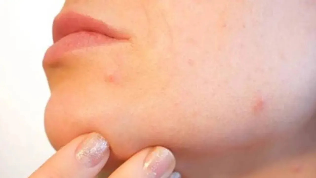 acne|beauty tips|skincare