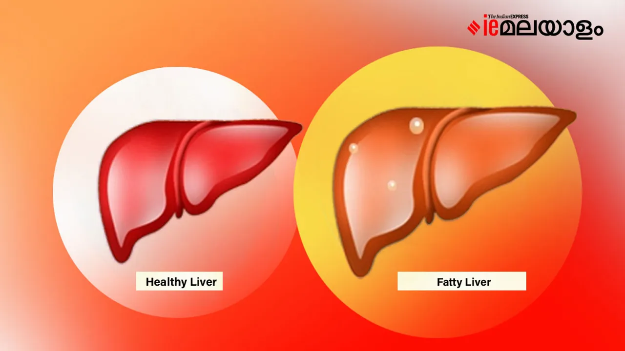 Fatty liver|healthy|Fatty liver and alcohol consumption| Diet for fatty liver|