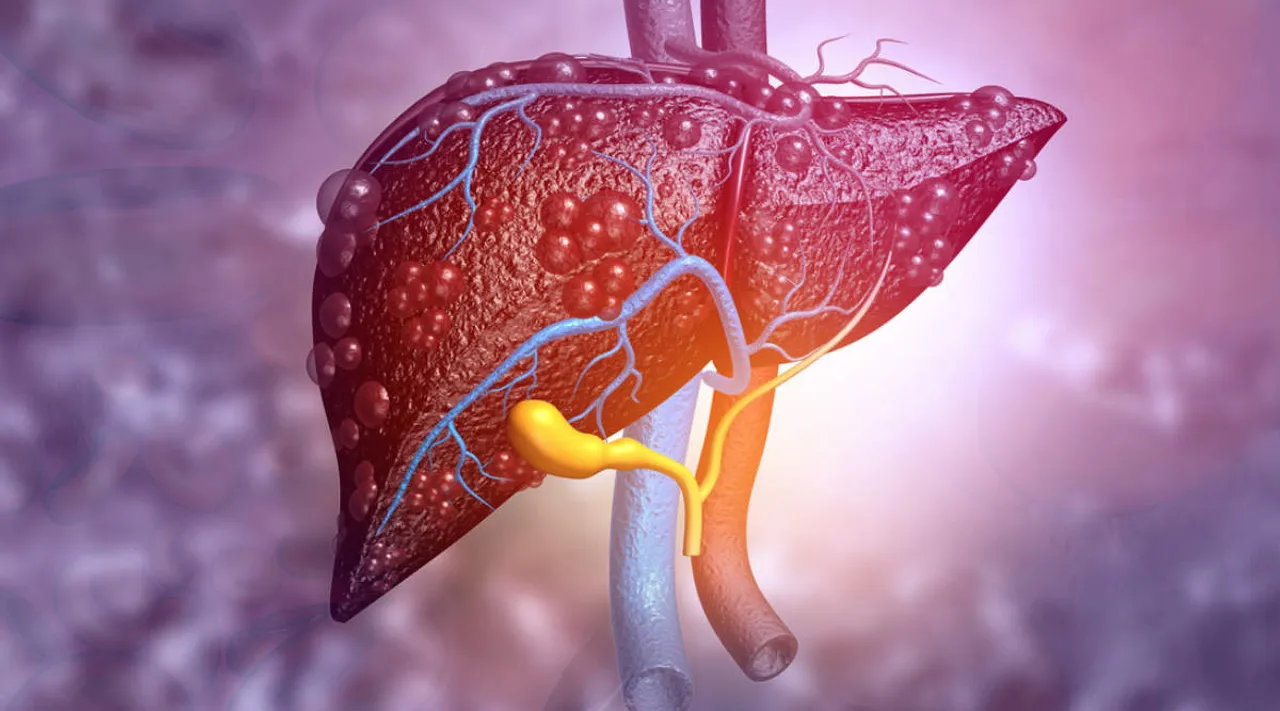 liver cirrhosis