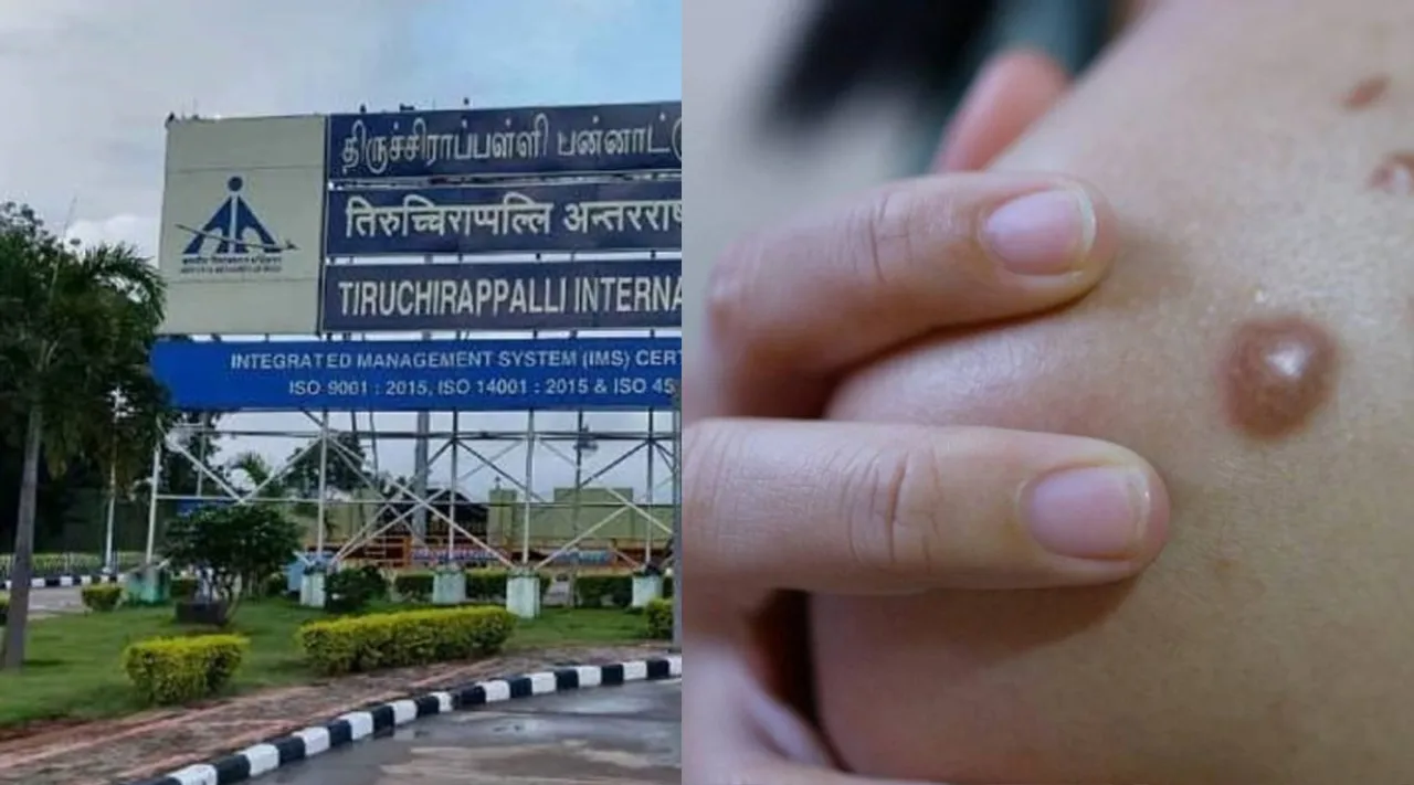 Trichy monkeypox