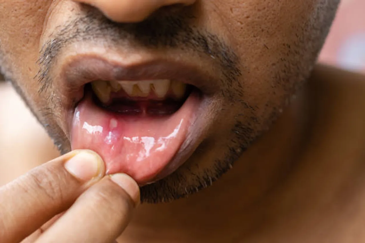 mouth ulcer