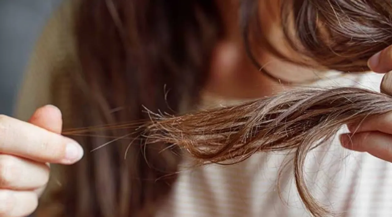 Hairloss