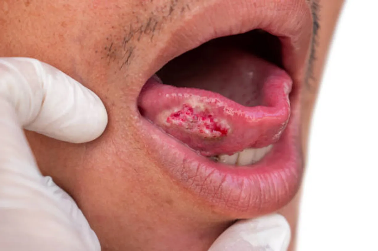 mouth cancer