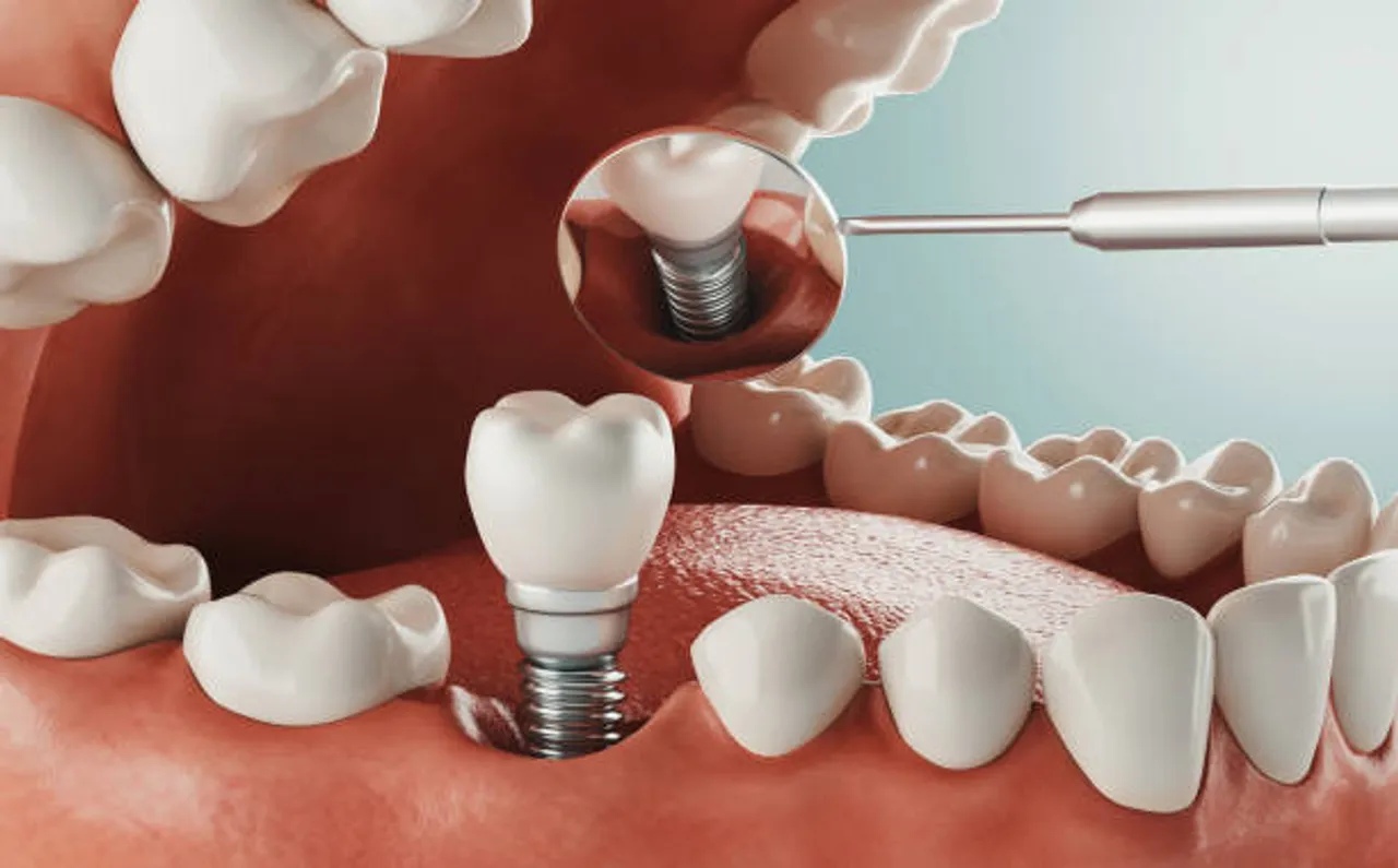 tooth implant