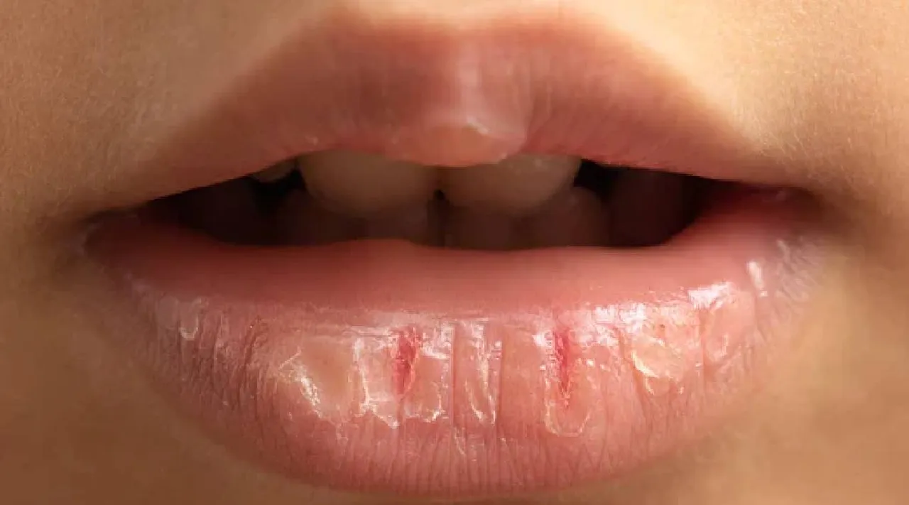 Lip crack