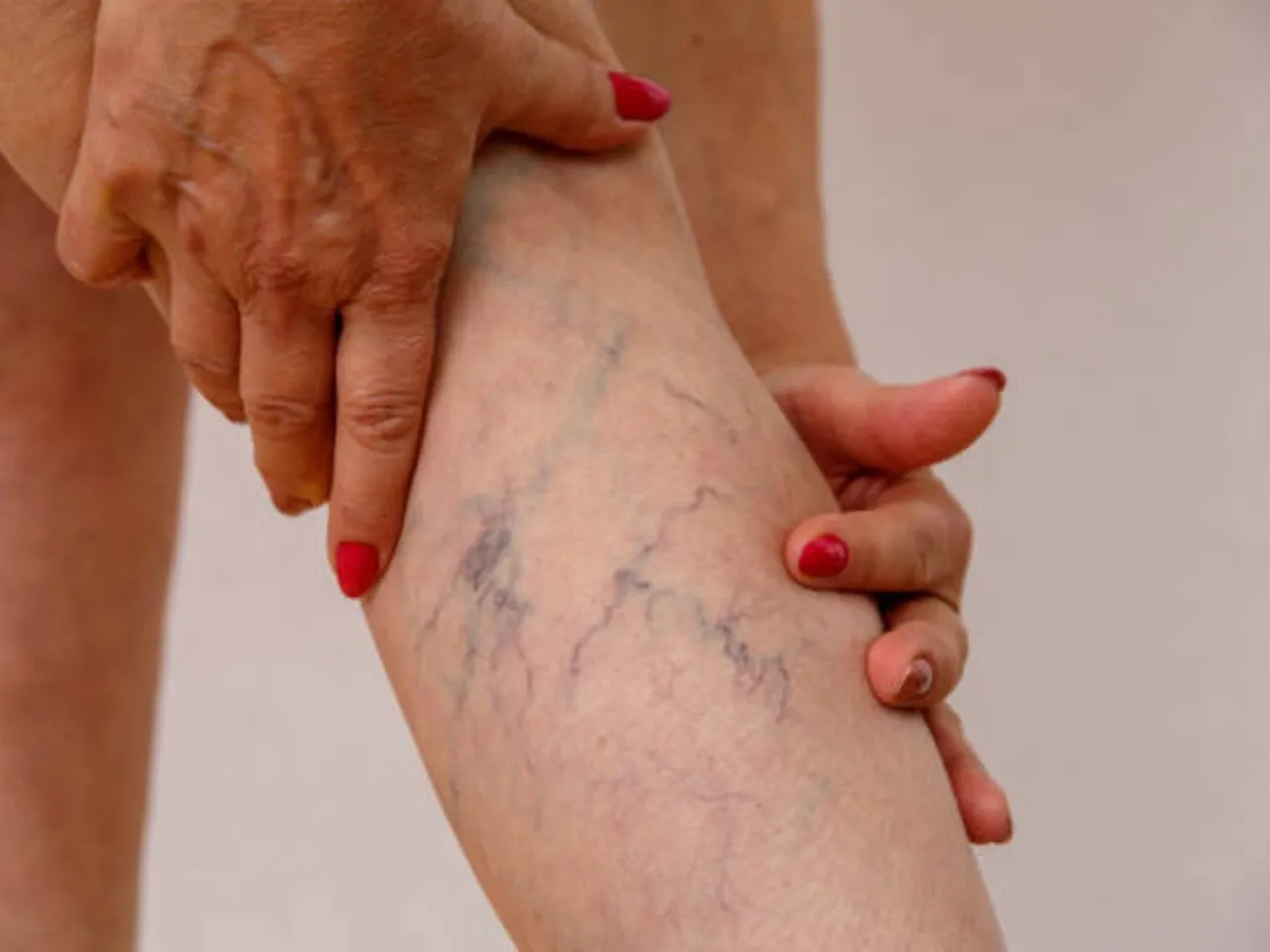 varicose veins