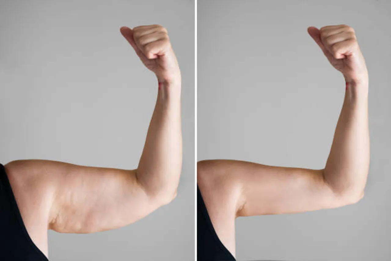 arm fat