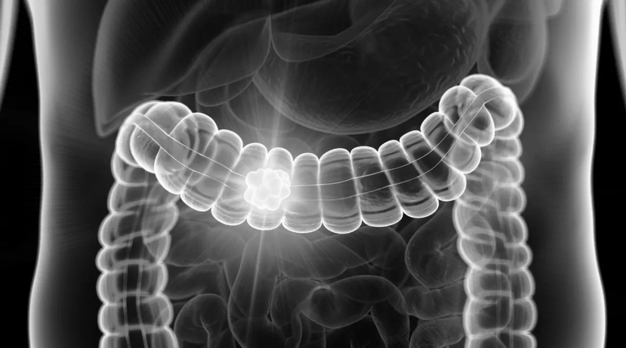 intestine cancer