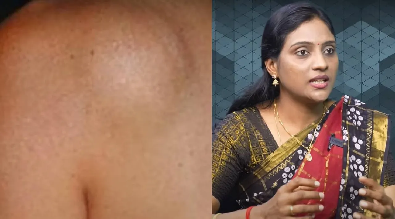 Lipoma home remedy