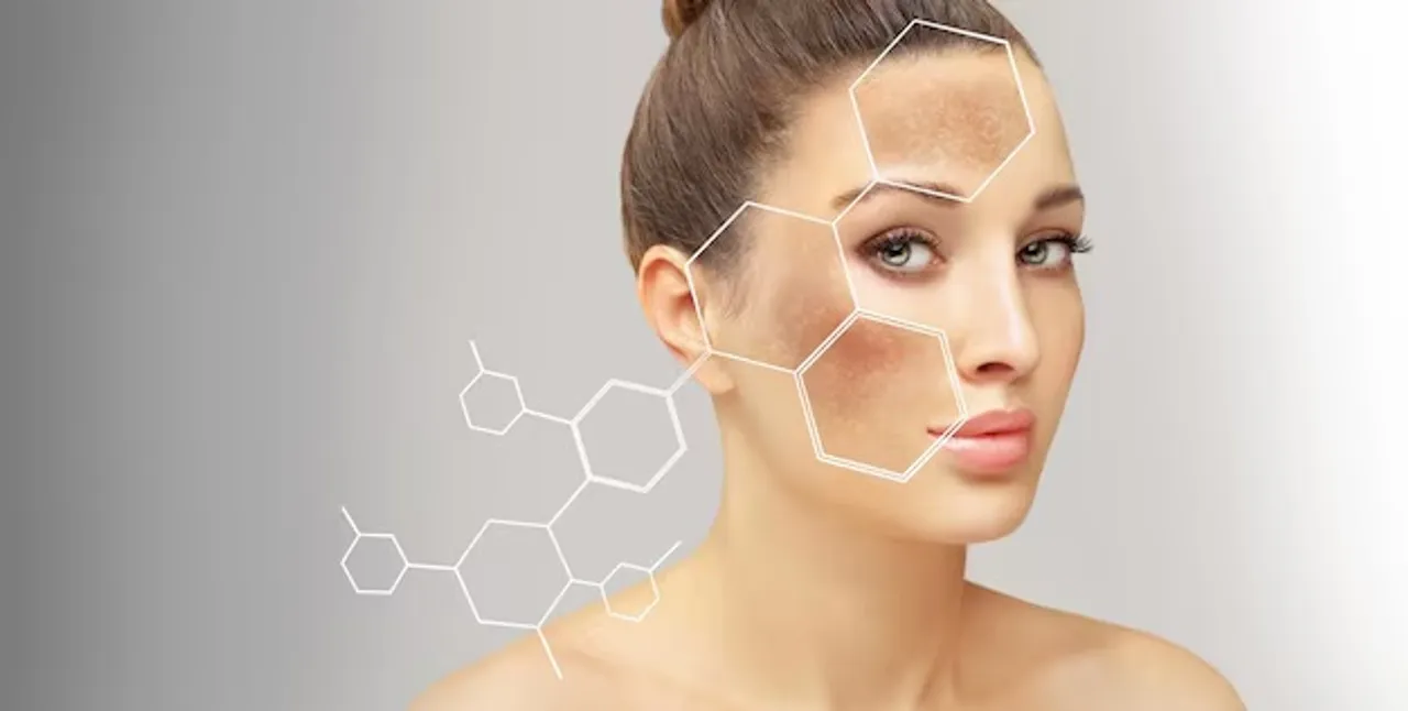 Melasma Home Remedies