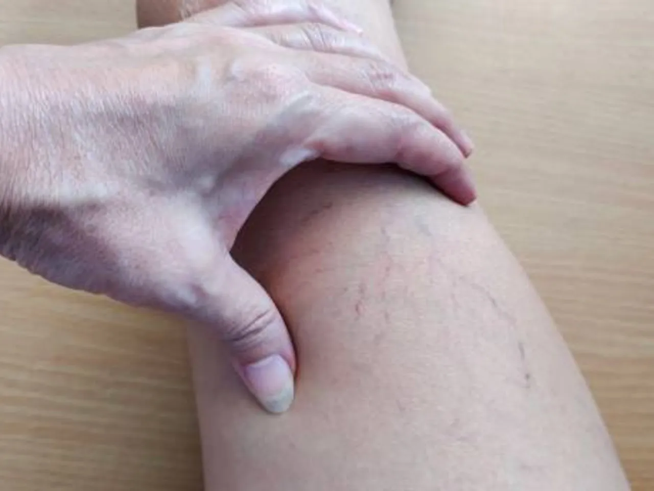 varicose veins