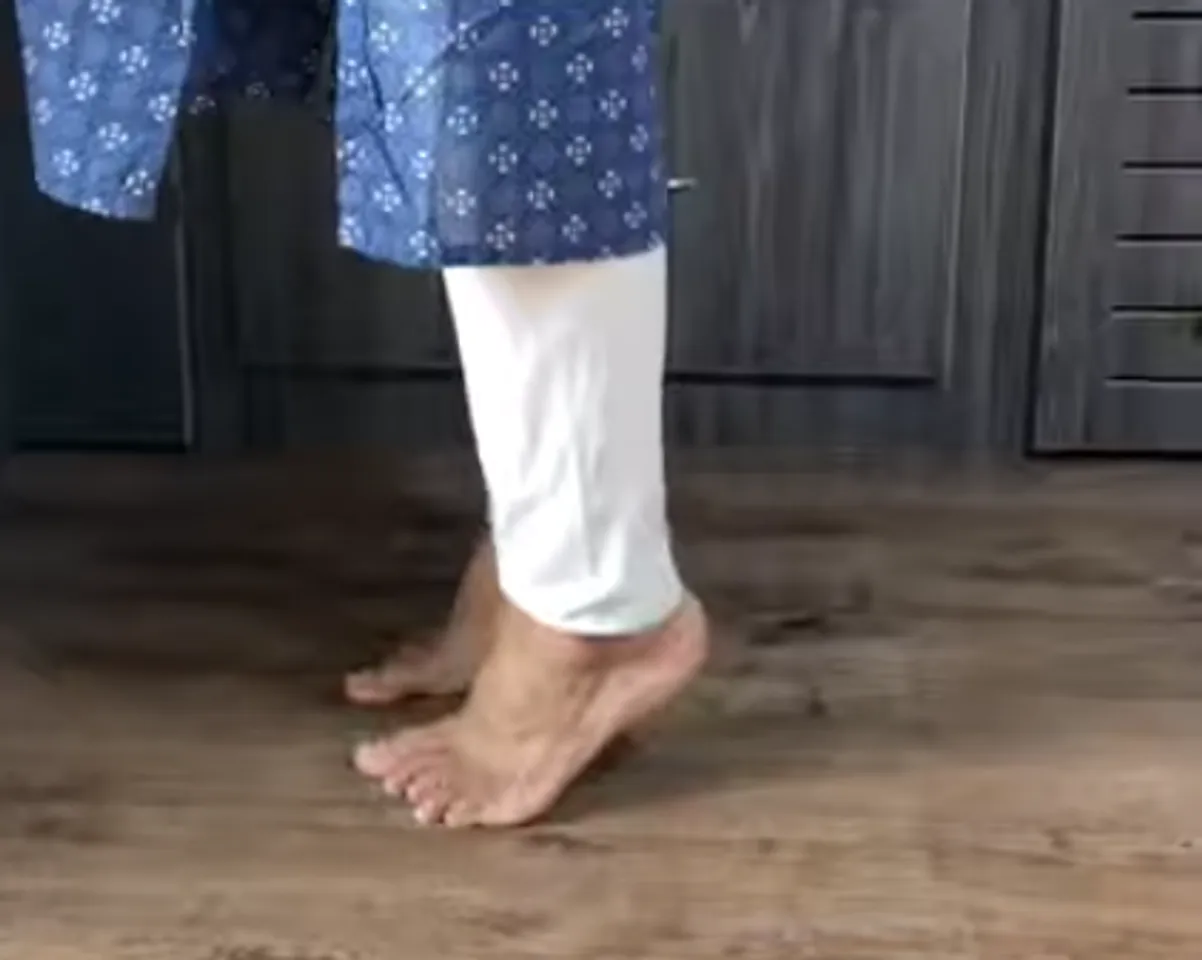 varicose veins