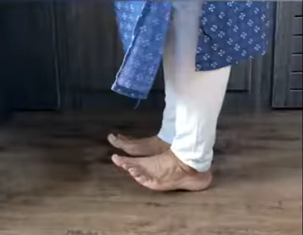varicose veins