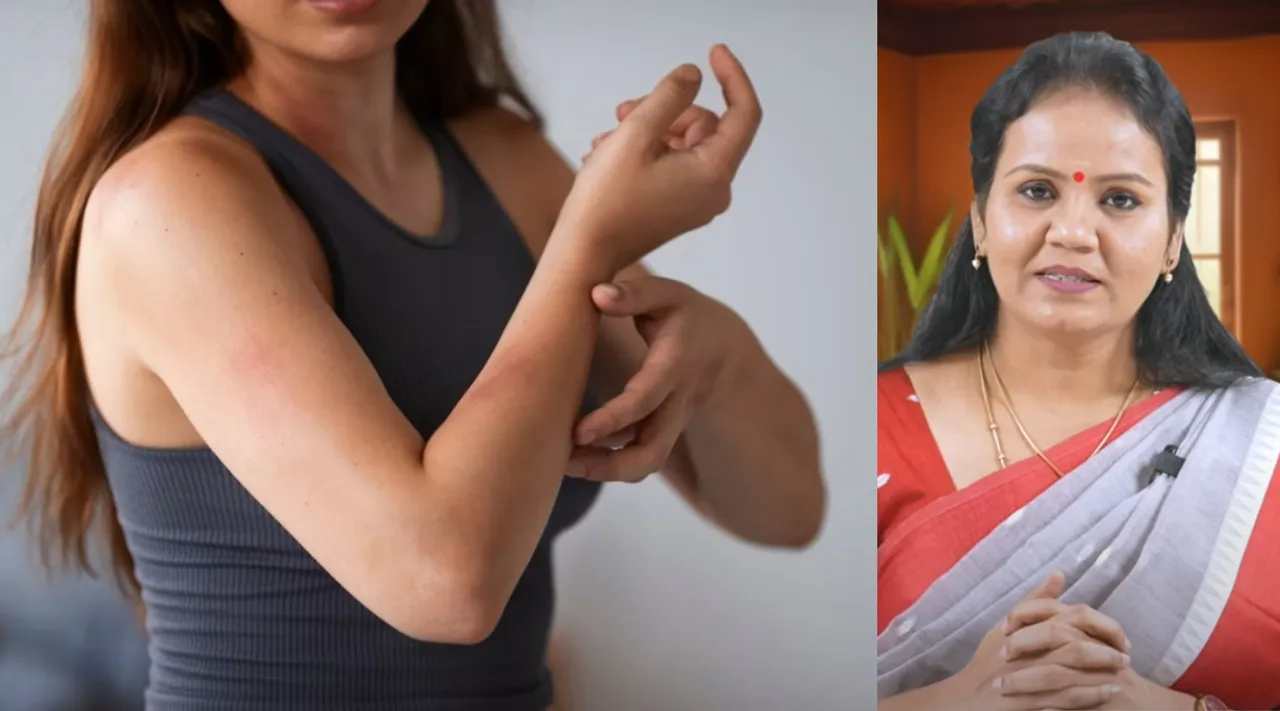 psoriasis