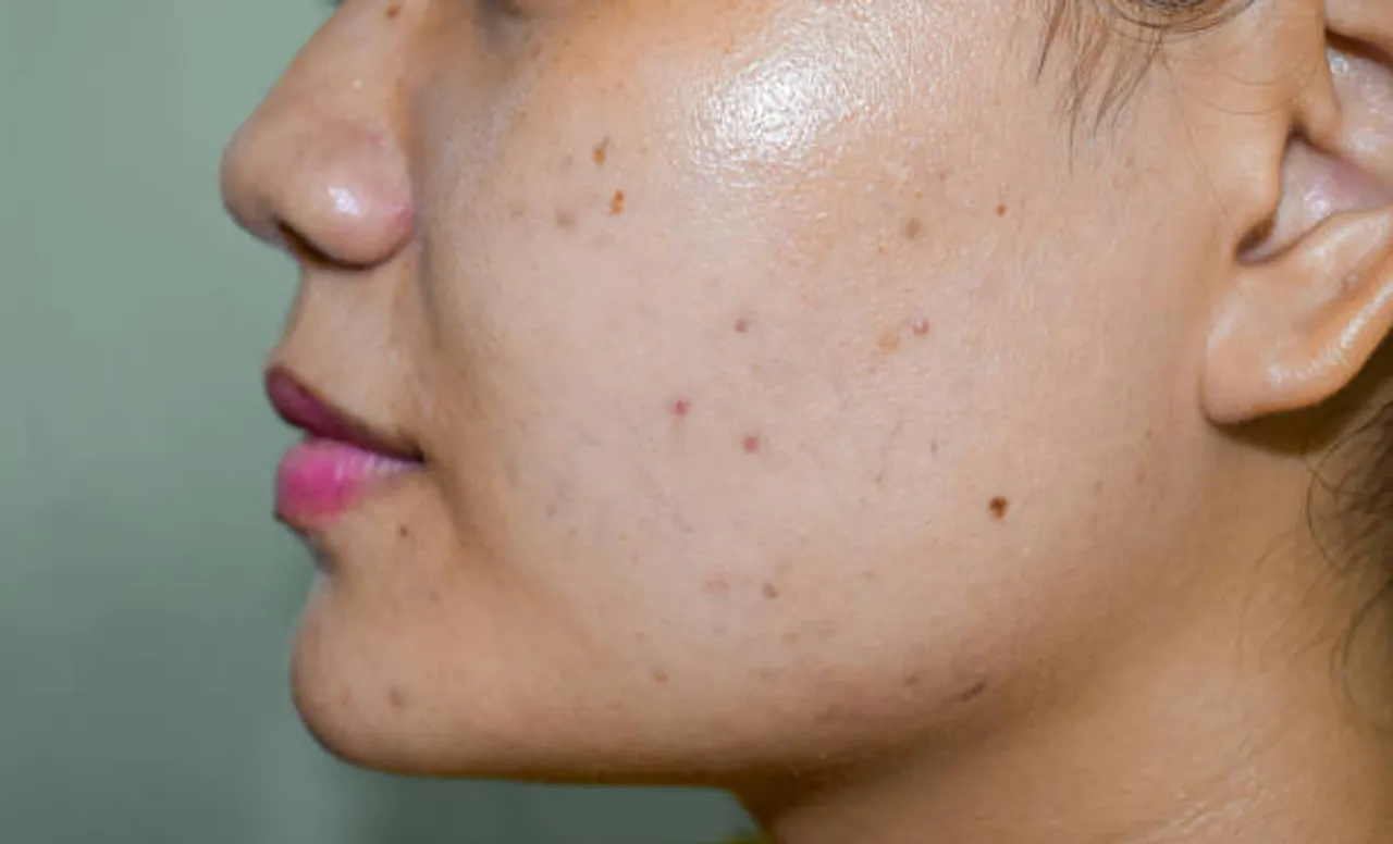 oily skin