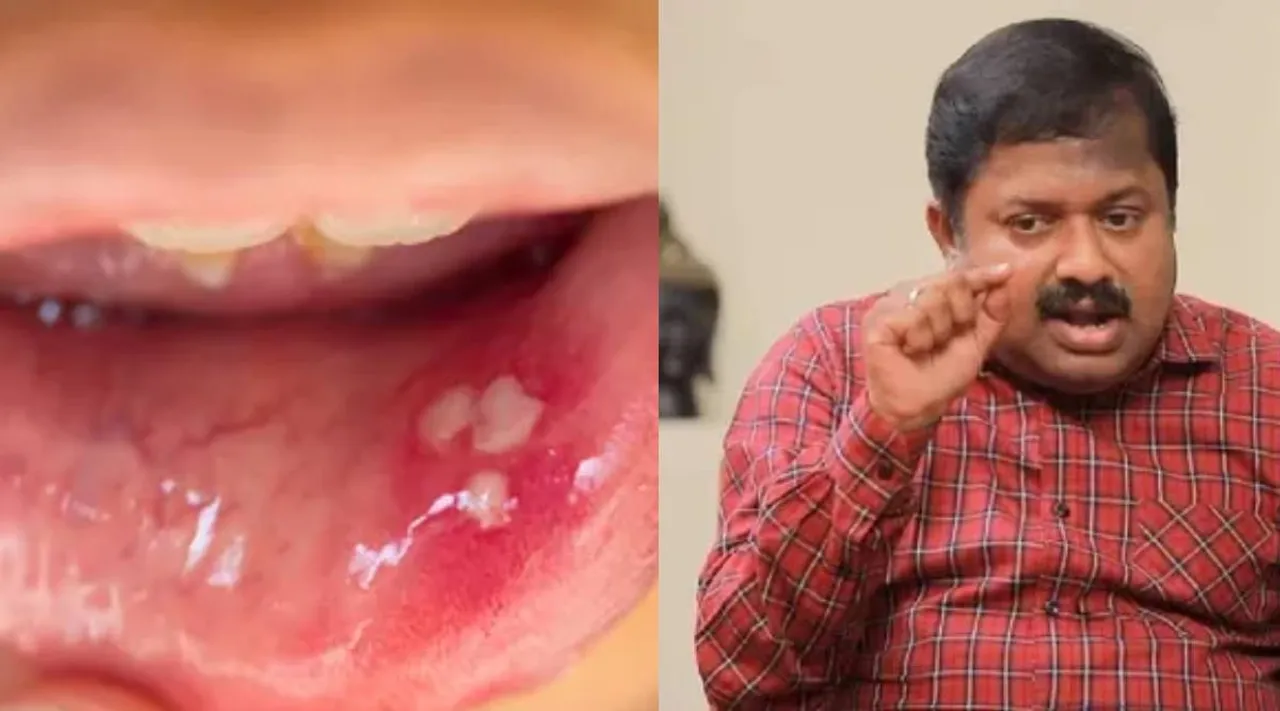 Mouth ulcer