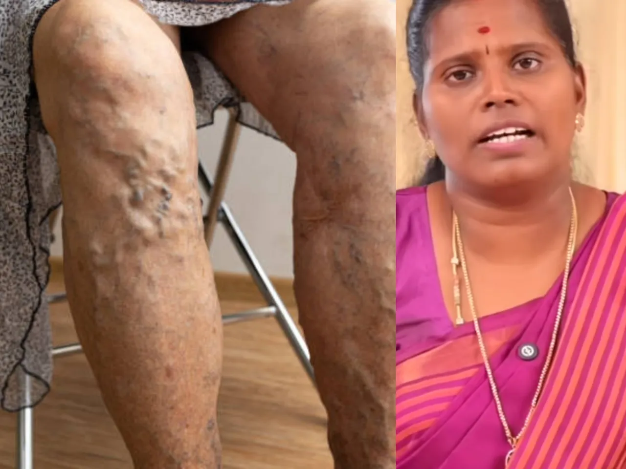 varicose veins