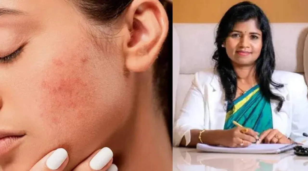 Pimple remedies